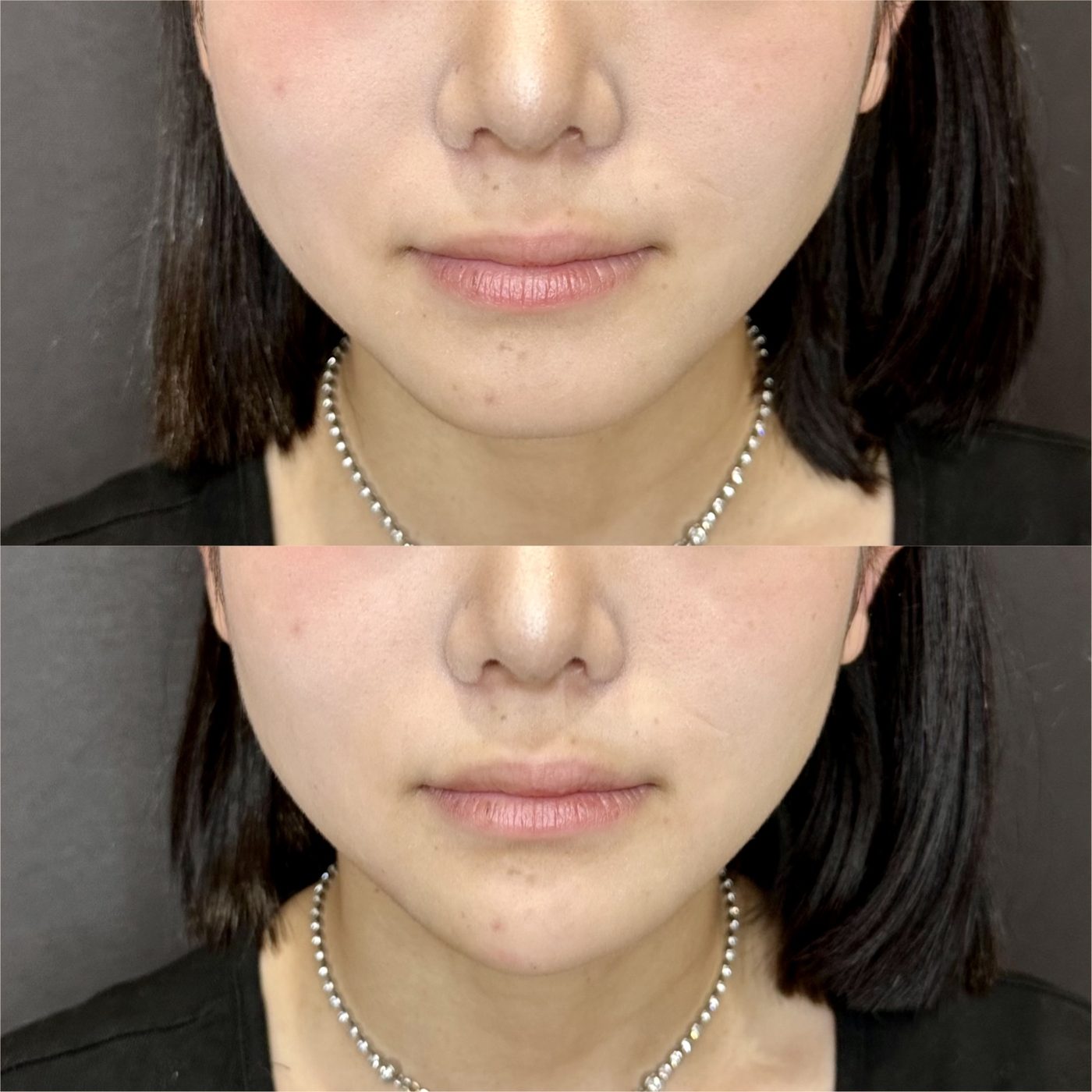 顎ヒアルロン酸の症例（ボラックス・20代女性）。注入前と注入後の比較