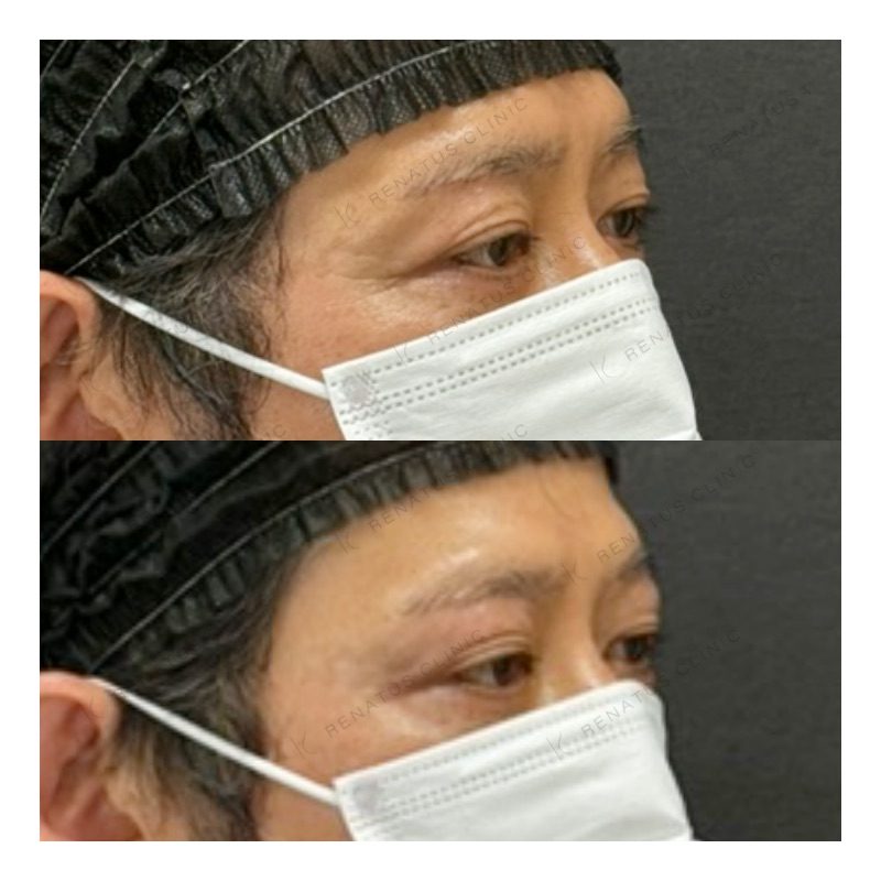 ヒアルロン酸 福岡 上手|天神の目のくぼみ ヒアルロン酸 名医・費用【公式】 32 目の上(目のくぼみ)ヒアルロン酸の症例(ボルベラ・50代男性)。注入前と注入後の比較