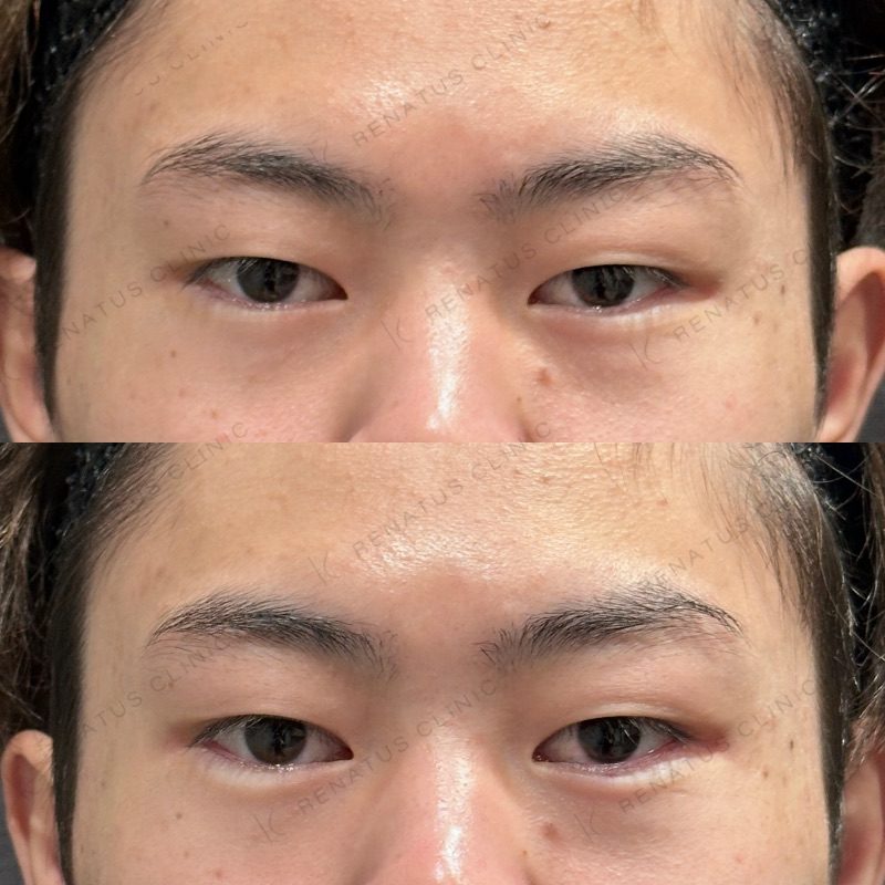 仙台の涙袋ヒアルロン酸が上手い先生・名医と安いおすすめのクリニック 22 涙袋ヒアルロン酸の症例(ボルベラ・10代男性)。注入前と注入後の比較