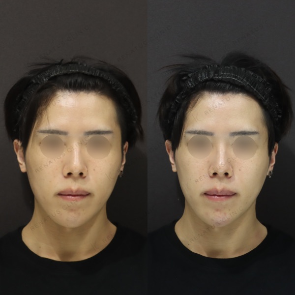 顎ヒアルロン酸の症例（ボラックス・30代男性）。注入前と注入後の比較