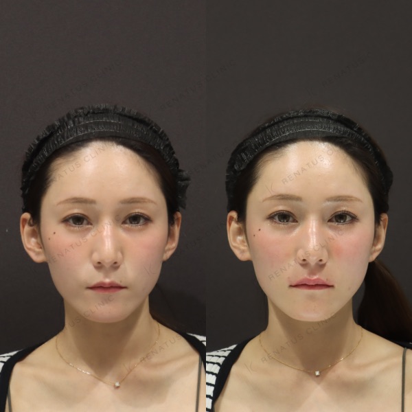 唇ヒアルロン酸は何cc必要? 20 唇ヒアルロン酸の症例(ボルベラ・20代女性)。注入前と注入後の比較