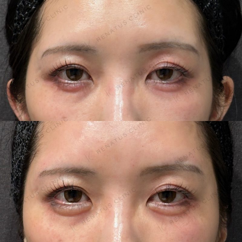 仙台の涙袋ヒアルロン酸が上手い先生・名医と安いおすすめのクリニック 19 涙袋ヒアルロン酸の症例(ボルベラ・20代女性)。注入前と注入後の比較