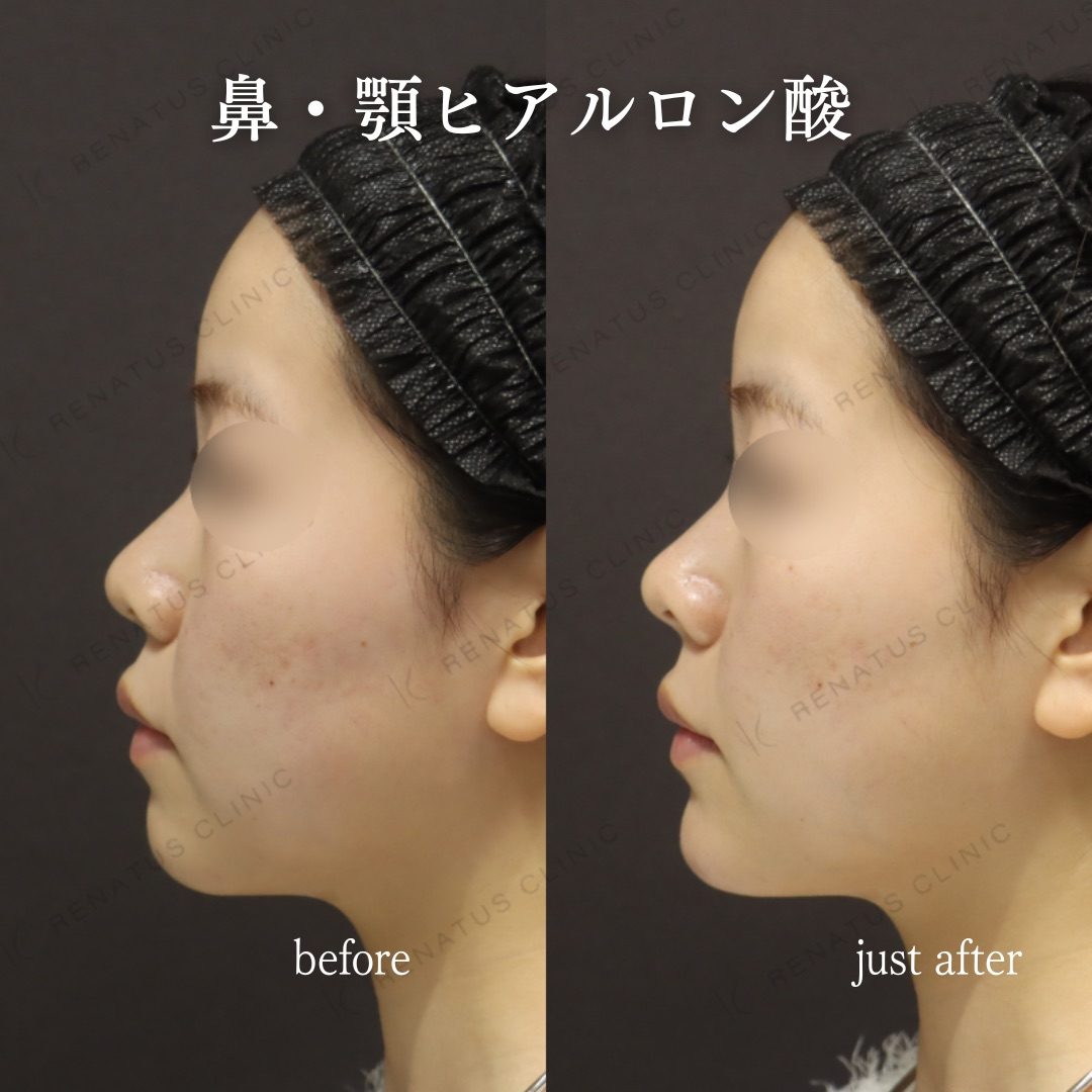 顎ヒアルロン酸の症例（ボラックス・20代女性）。注入前と注入後の比較
