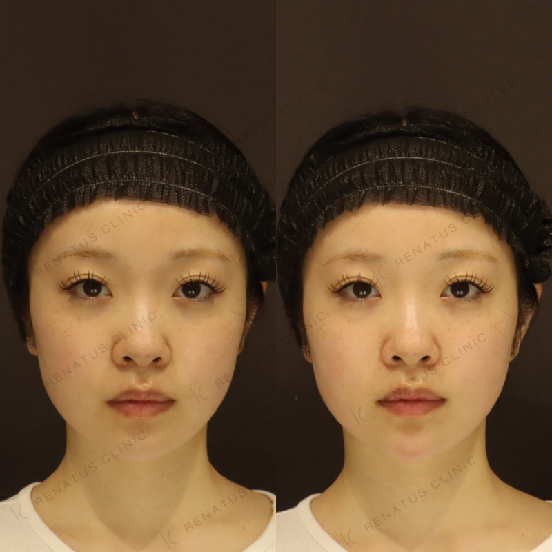 顎ヒアルロン酸の症例（ボラックス・20代女性）。注入前と注入後の比較