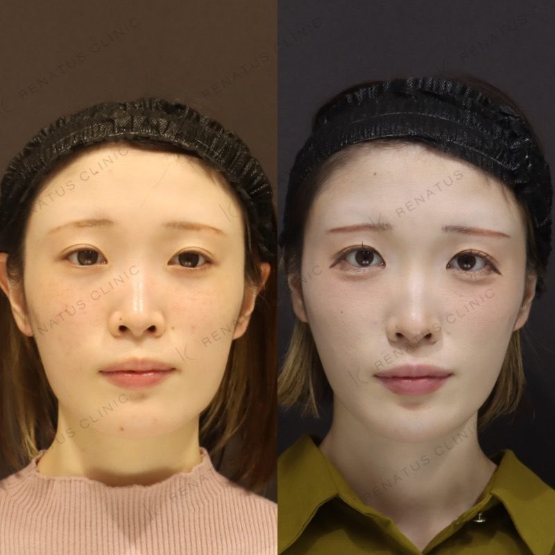大阪の糸リフトが上手い先生・名医と安いおすすめのクリニックと口コミ 13 糸リフトの症例(糸リフト・20代)。施術前と施術後の比較