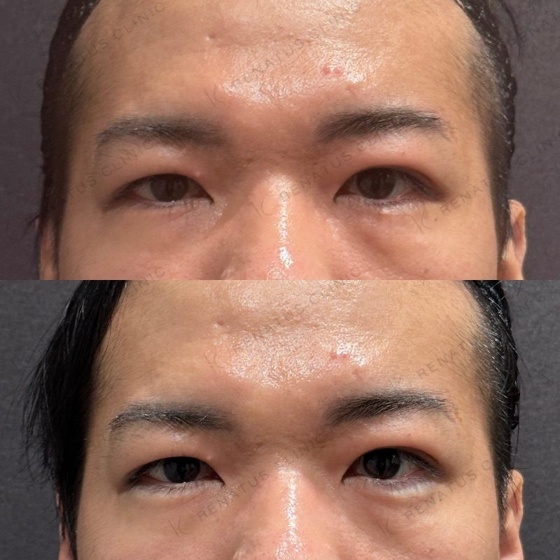 仙台の涙袋ヒアルロン酸が上手い先生・名医と安いおすすめのクリニック 14 涙袋ヒアルロン酸の症例(ボルベラ・30代男性)。注入前と注入後の比較