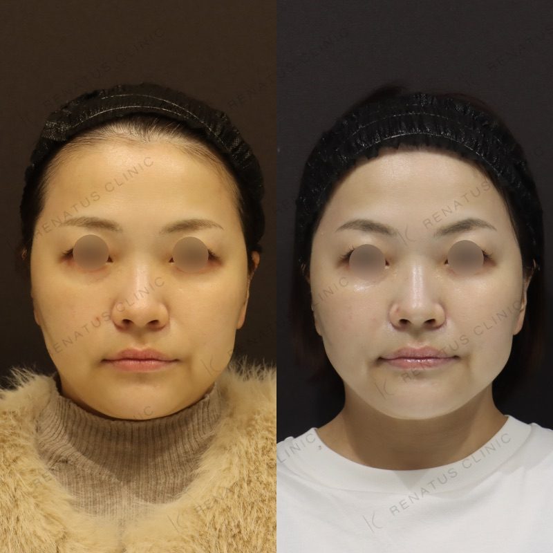 ボライト（スキンバイブ）の症例（ボライト・40代女性）。注入前と注入後の比較