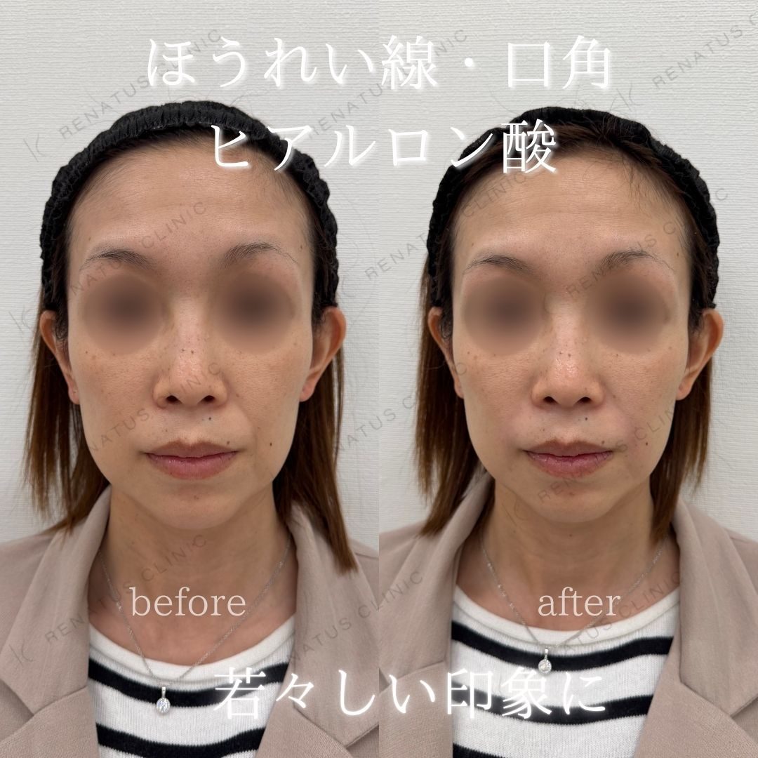 ほうれい線ヒアルロン酸の症例（ボリフト・30代女性・仙台）。注入前と注入後の比較