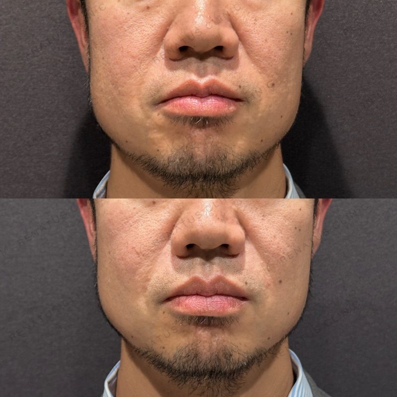 ほうれい線ヒアルロン酸の症例（ボリフト・30代男性・東京）。注入前と注入後の比較
