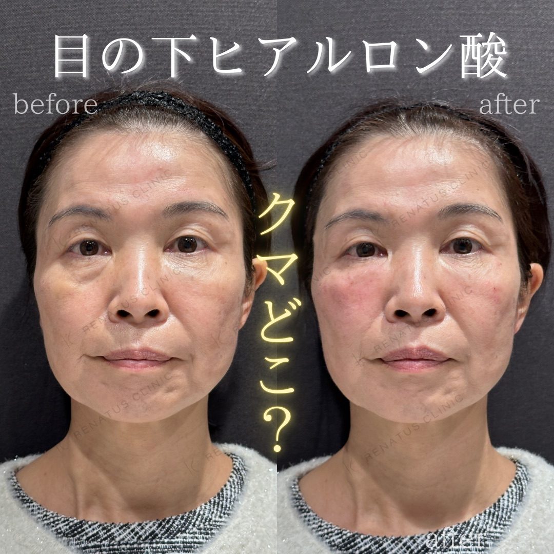 目の下のシワをなくす方法 16 目の下(眼窩縁)ヒアルロン酸の症例(ボルベラ・50代女性)。注入前と注入後の比較