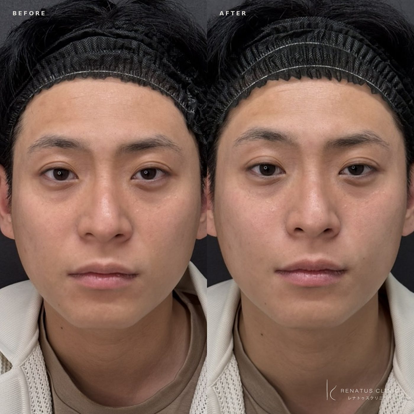 ほうれい線ヒアルロン酸のデメリットとは? 18 ほうれい線ヒアルロン酸の症例(ボリフト・30代男性)。注入前と注入後の比較