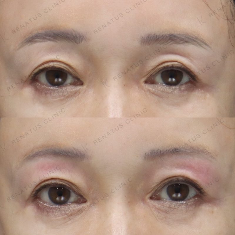 目の上（目のくぼみ）ヒアルロン酸の症例（ボルベラ・50代女性）。注入前と注入後の比較