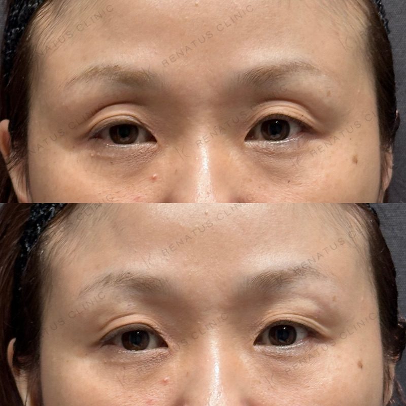 目のくぼみ・目の上のくぼみ ヒアルロン酸の費用・何cc・持ち|名医の選び方 39 目の上(目のくぼみ)ヒアルロン酸の症例(ボルベラ・40代女性)。注入前と注入後の比較