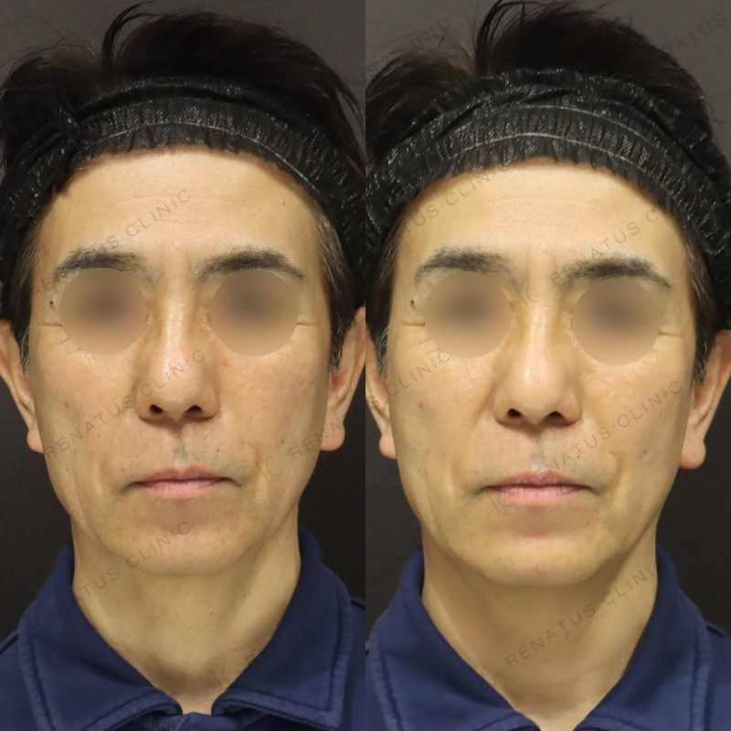 顎ヒアルロン酸の症例（ボラックス・60代男性）。注入前と注入後の比較