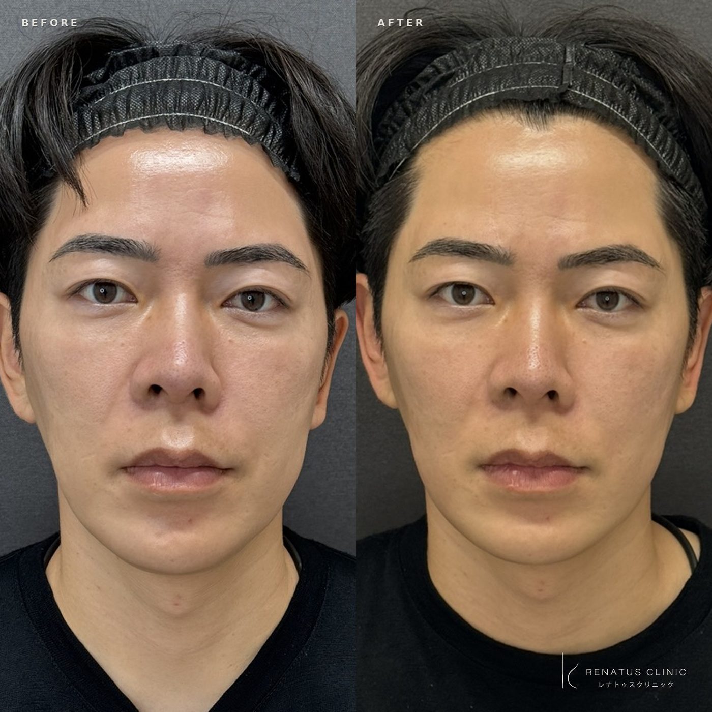 ザーフとハイフの違い|効果・痛み・持続期間とどちらを選ぶかを医師が解説 11 福岡天神院・30代男性・ザーフのビフォーアフター・正面