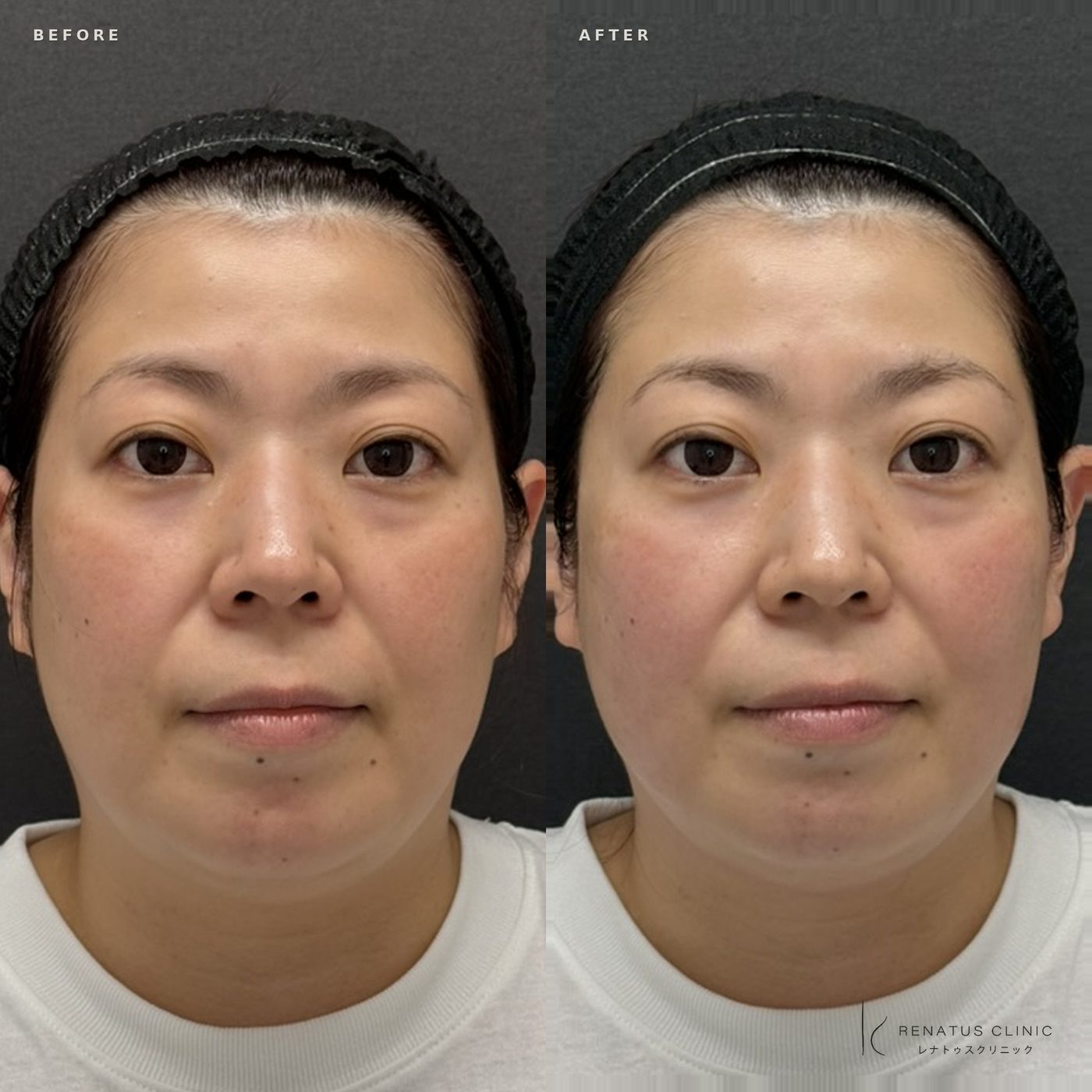 ザーフとハイフの違い|効果・痛み・持続期間とどちらを選ぶかを医師が解説 12 福岡天神院・40代女性・ザーフのビフォーアフター・正面