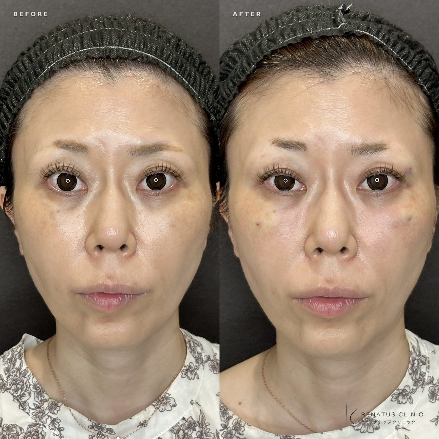 目の上（目のくぼみ）ヒアルロン酸の症例（ボルベラ・30代女性）。注入前と注入後の比較
