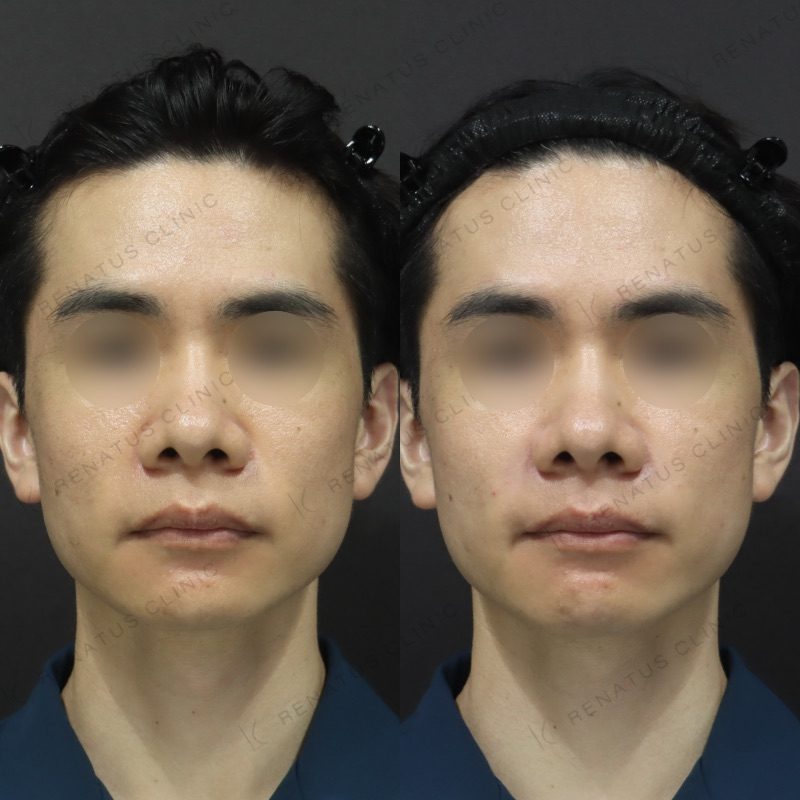 ほうれい線ヒアルロン酸のデメリットとは? 7 ほうれい線ヒアルロン酸の症例(ボリフト・30代男性)。注入前と注入後の比較