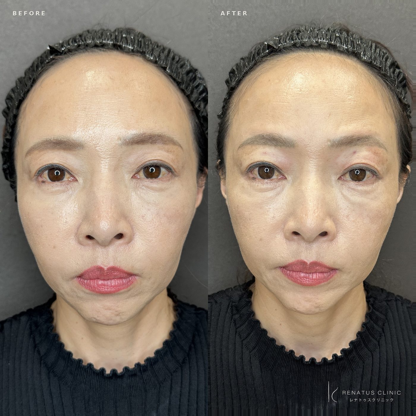 目の上（目のくぼみ）ヒアルロン酸の症例（ボルベラ・50代女性）。注入前と注入後の比較