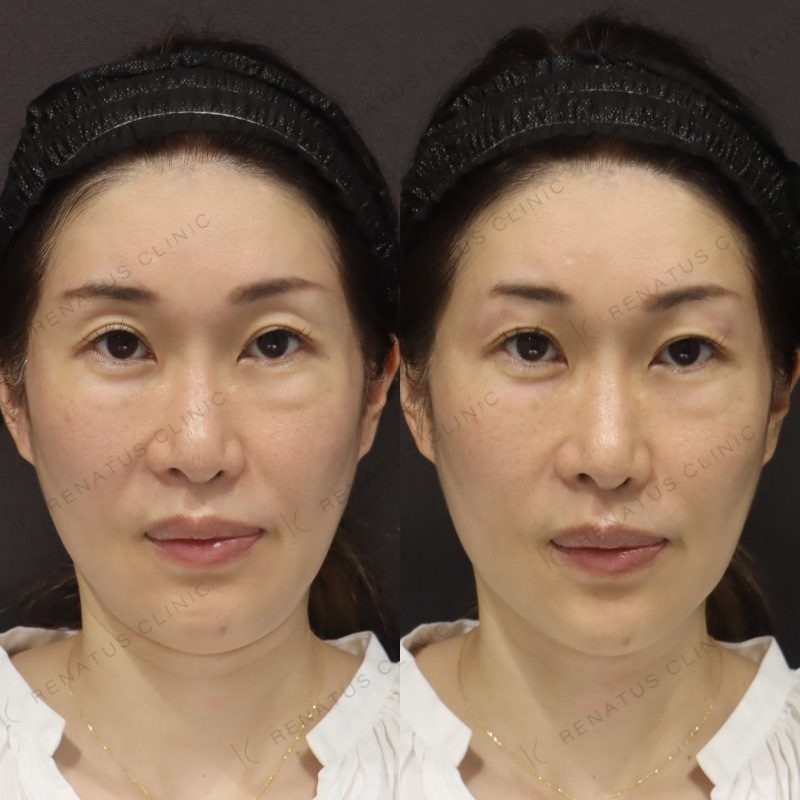 目のくぼみ ヒアルロン酸 名医 名古屋|症例・費用・失敗しないために【公式】 40 目の上(目のくぼみ)ヒアルロン酸の症例(ボルベラ・40代女性)。注入前と注入後の比較