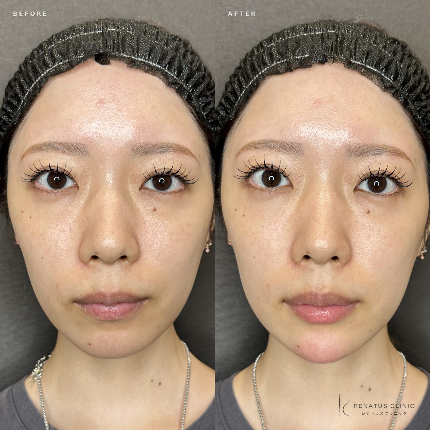 顎ヒアルロン酸の症例（ボラックス・20代女性）。注入前と注入後の比較