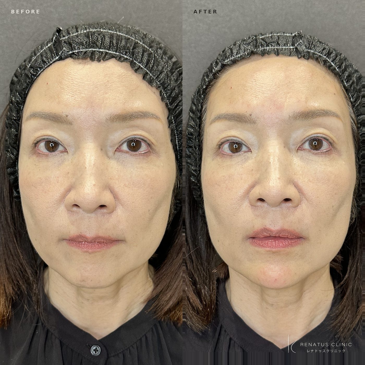 顎ヒアルロン酸の症例（ボラックス・50代女性）。注入前と注入後の比較