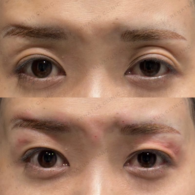 目の上（目のくぼみ）ヒアルロン酸の症例（ボルベラ・40代女性）。注入前と注入後の比較