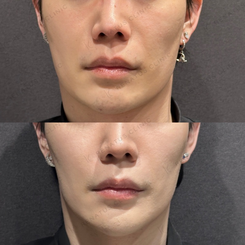 糸リフトの症例（30代男性）。施術前と施術後の比較
