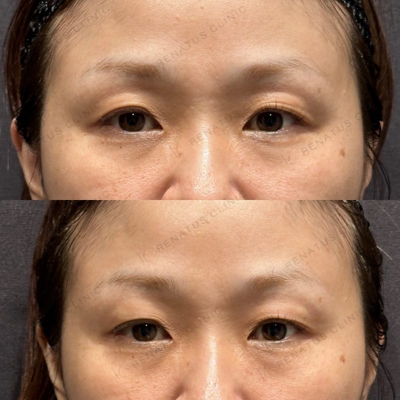 目の上（目のくぼみ）ヒアルロン酸の症例（ボルベラ・40代女性）。注入前と注入後の比較
