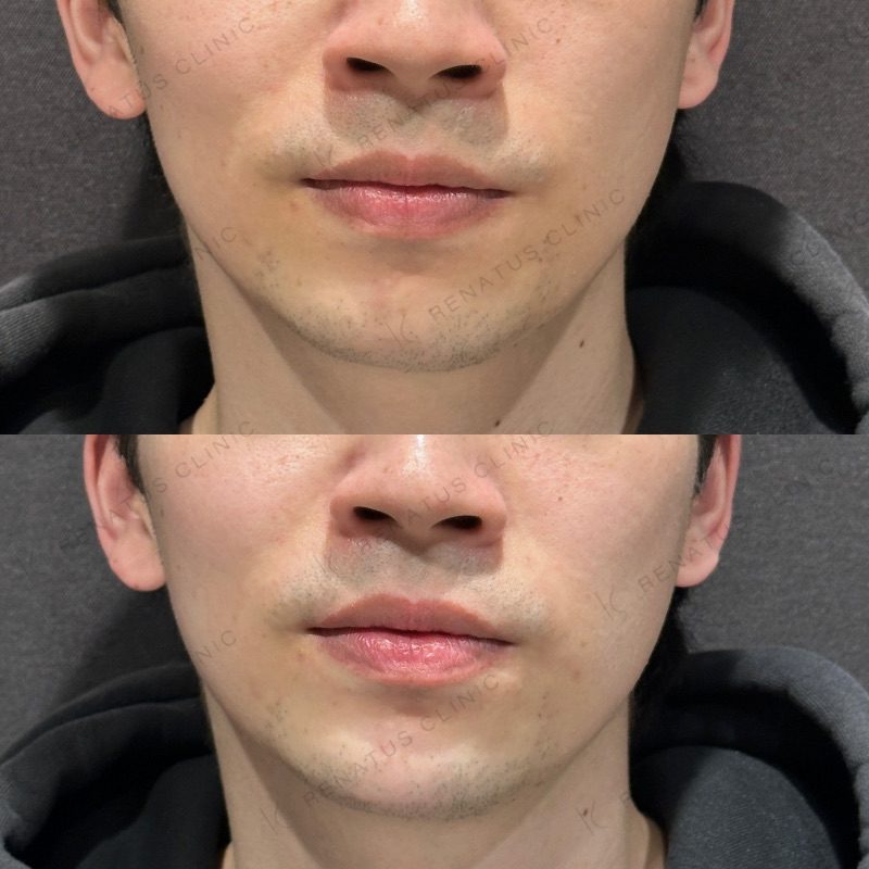 顎ヒアルロン酸の症例（20代男性・東京）。注入前と注入後の比較