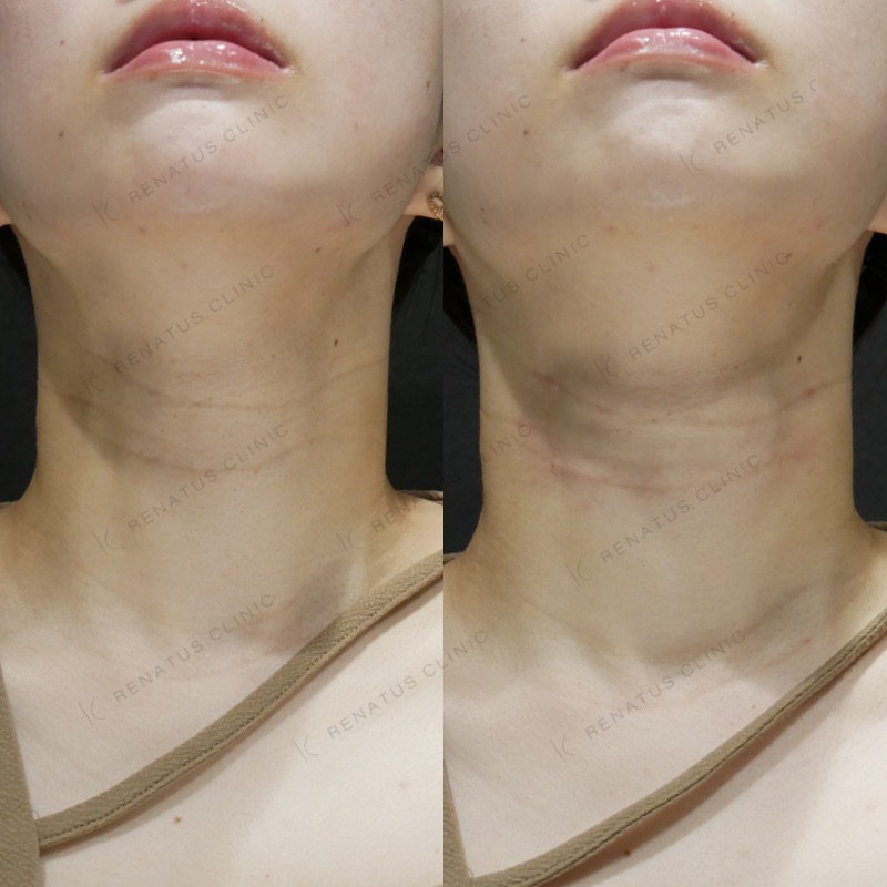 スキンバイブとは(SKINVIVE)|効果・料金・ダウンタイム・副作用を専門医が解説【レナトゥスクリニック】 16 ボライト(スキンバイブ)の症例(ボライト・20代女性)。注入前と注入後の比較