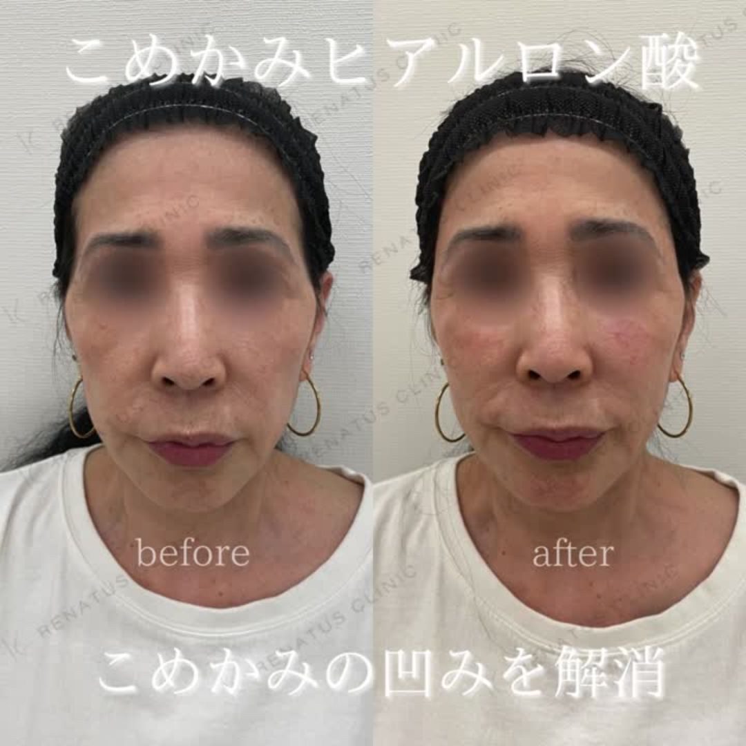 こめかみのヒアルロン酸注入 22 こめかみヒアルロン酸の症例(ボリューマ・60代女性)。注入前と注入後の比較