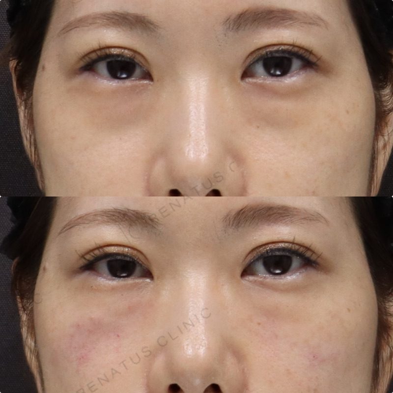 目の下のシワをなくす方法 14 目の下(眼窩縁)ヒアルロン酸の症例(ボルベラ・30代女性)。注入前と注入後の比較