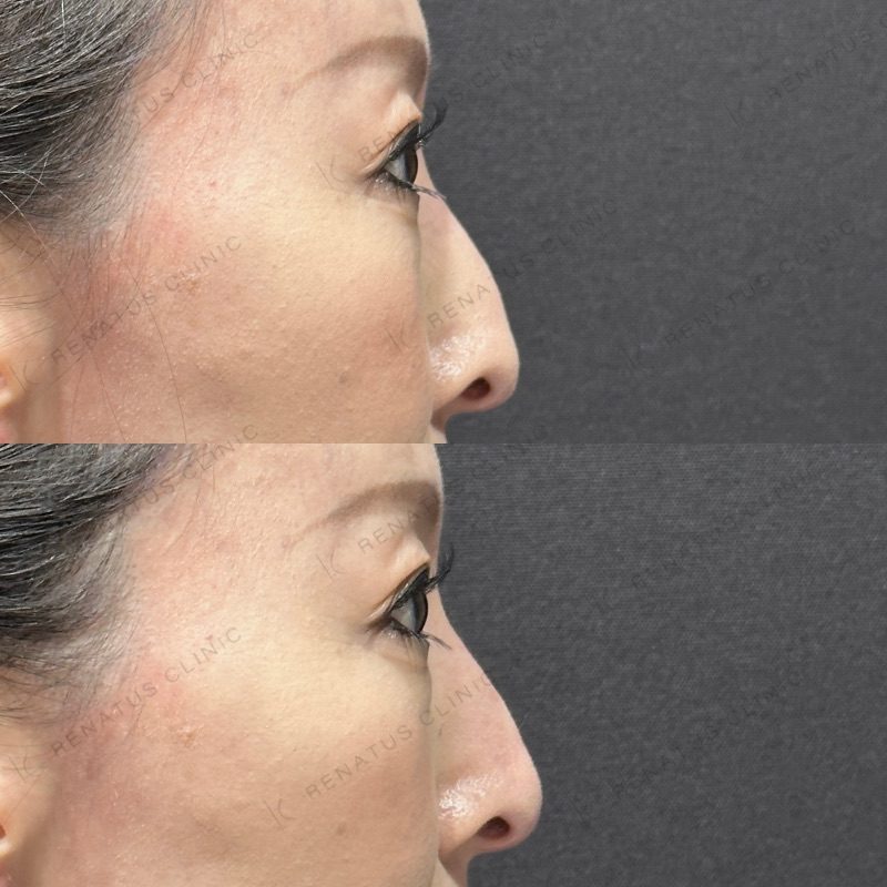 鼻ヒアルロン酸 デメリット|太くなる、バレるリスクと失敗しない方法も紹介 37 鼻ヒアルロン酸の症例(ボラックス・40代女性)。注入前と注入後の比較