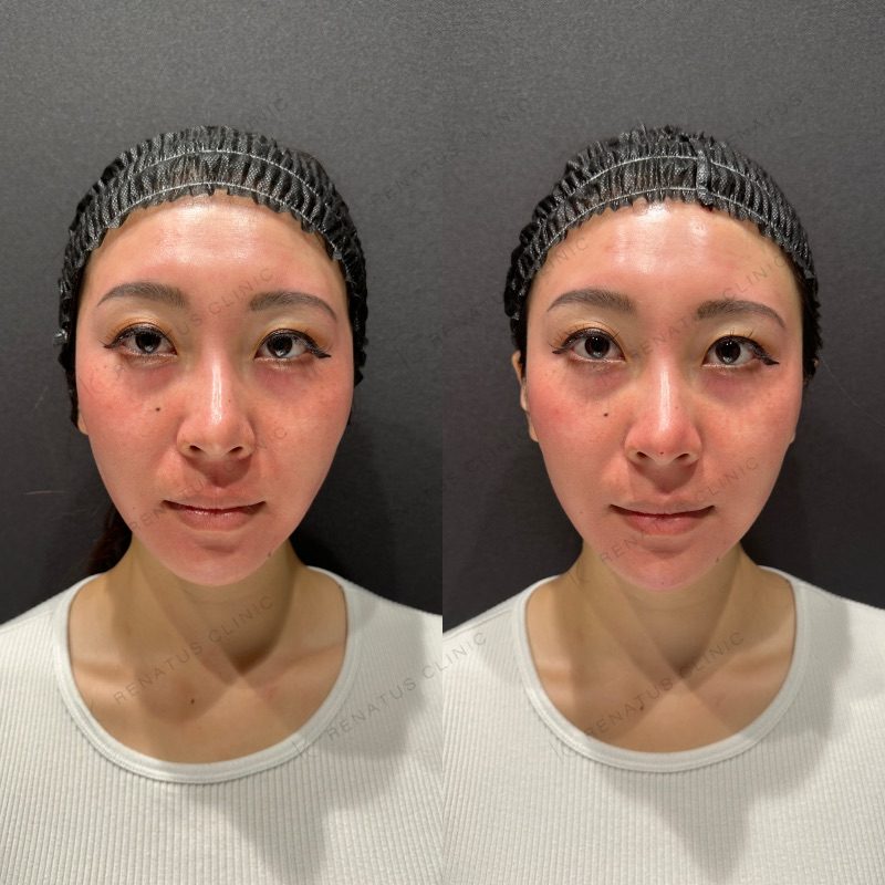 鼻ヒアルロン酸 デメリット|太くなる、バレるリスクと失敗しない方法も紹介 33 鼻ヒアルロン酸の症例(ボラックス・20代女性)。注入前と注入後の比較
