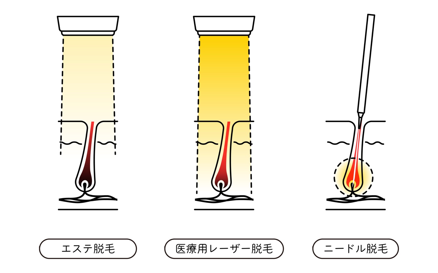 医療レーザー脱毛と針（ニードル）脱毛の仕組みの違い
