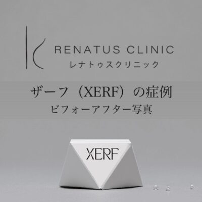 ザーフ（XERF）の症例｜レナトゥスクリニック