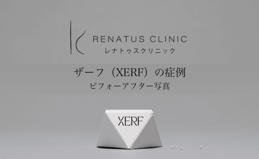 ザーフ（XERF）の症例｜レナトゥスクリニック